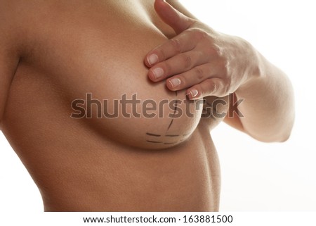 Woman displaying the surgical guidelines marked out by the surgeon for a mastectomy or breast implant on a naked female breast closeup view isolated on white Woman displaying the surgical guidelines marked out by the surgeon for a mastectomy or breast implant on a naked female breast closeup view isolated on white