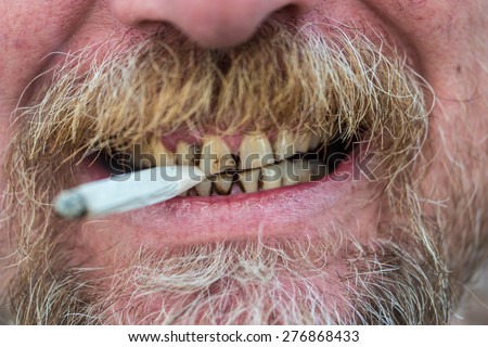 Close up of the mouth of a man with a beard and mustache smoking a cigarette, clamping it between tobacco stained teeth