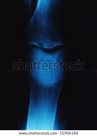 X-ray of the knee-joints over a black background.