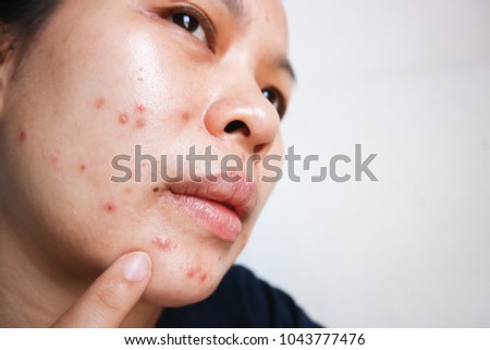Asian women face acne lesions. Clogged pores Chemicals and dust cause acne. Good health requires acne on the face.