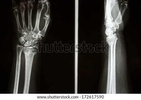 Film X-ray show fracture distal radius (Colles\' fracture) (Wrist)