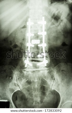 is spondylolithesis is spondylolithesis