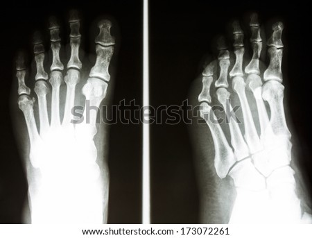film X-ray show normal bone of human\'s foot