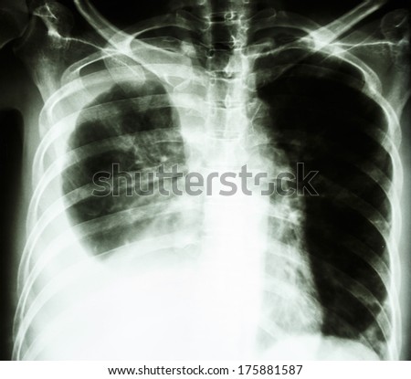 film chest X-ray PA upright : show pleural effusion at right lung due to lung cancer