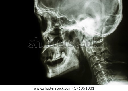 Film x-ray Skull lateral : show normal human\'s skull and blank area at left side