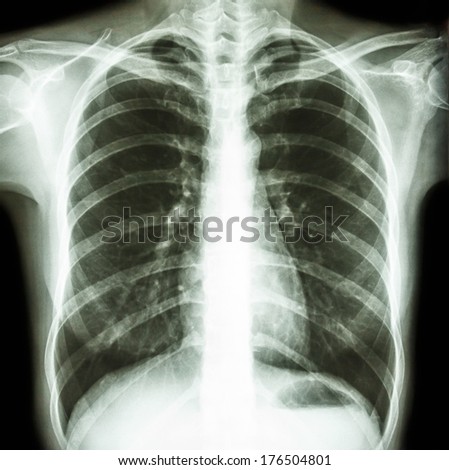 Film chest x-ray PA upright : show normal human\'s chest