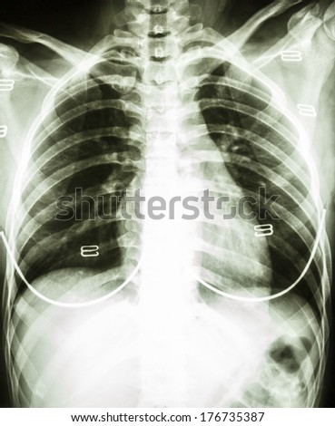 film chest x-ray : show normal woman\'s chest with bra