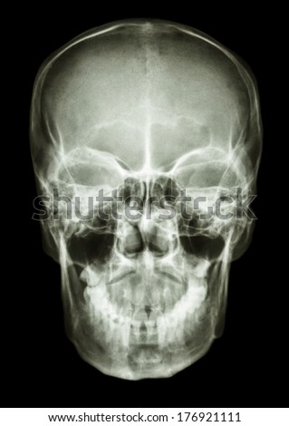 film x-ray skull AP : show normal human\'s skull