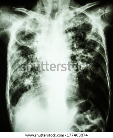 film chest x-ray show cavity at right lung,fibrosis & interstitial & patchy infiltrate at both lung due to Mycobacterium tuberculosis infection (Pulmonary Tuberculosis)