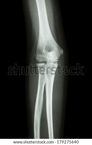 film x-ray elbow AP : show normal human\'s  elbow