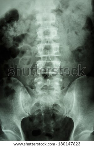 film x-ray L-S spine (lumbar-sacrum) : show normal human lumbar-sacrum spine