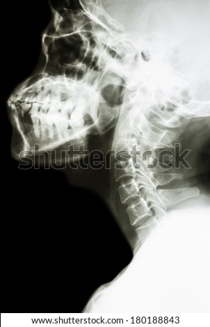 film x-ray cervical spine lateral : show normal thai man\'s cervical spine