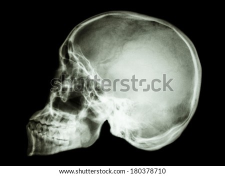 film x-ray skull lateral : show normal asian human\'s skull (Thai people)