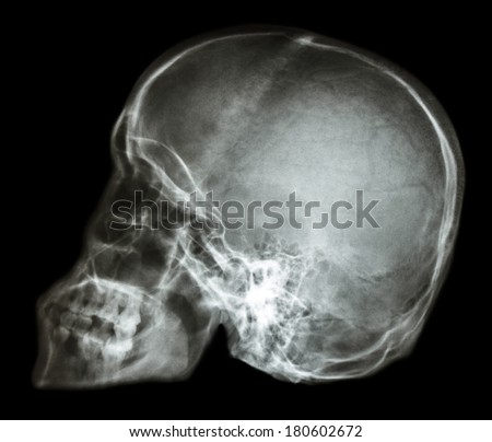 film x-ray skull lateral : show normal human\'s skull (Thai people)