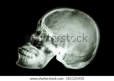 film x-ray normal human\'s skull (asian)