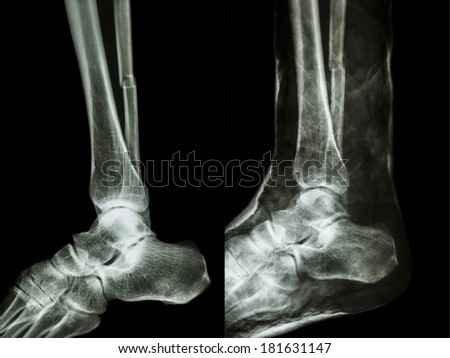 film x-ray fracture shaft of fibular(leg\'s bone) with cast(right image)