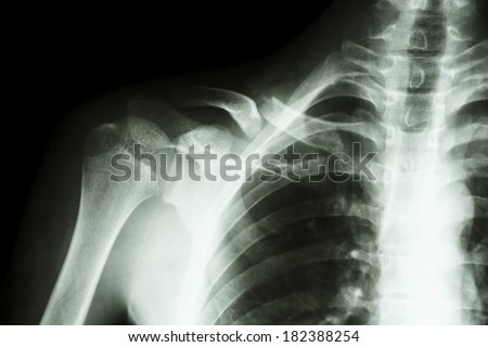 film x-ray right clavicle(collarbone) : show fracture right clavicle