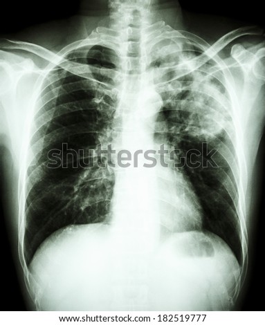film chest x-ray show alveolar infiltrate at left upper lung due to Mycobacterium tuberculosis infection (Pulmonary Tuberculosis)