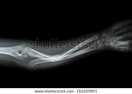 film x-ray forearm AP : show fracture shaft of ulnar(forearm\'s bone)