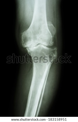film x-ray knee AP of osteoarthritis knee patient (OA knee)