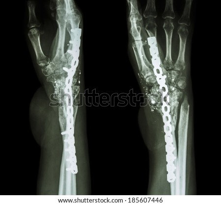 Fracture wrist and chronic infection. It was operated and internal fixed by plate and screw