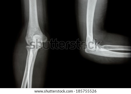 Film X-ray elbow AP(Antero-posterior)/lateral