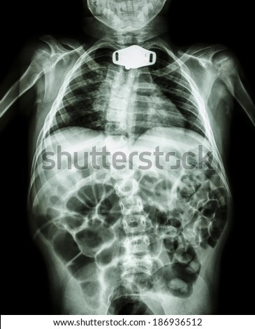 X-ray body of child and tracheostomy tube at neck area due to respiratory failure