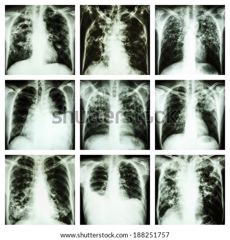 Collection of lung disease (Pulmonary tuberculosis,Pleural effusion,Bronchiectasis)