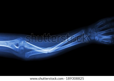 Fracture ulnar bone (forearm bone)