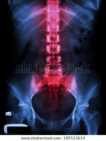 X-ray lumbo-sacral spine and pelvis and inflammation at spine