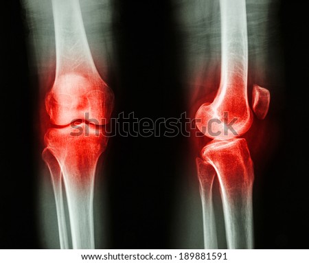 Film x-ray knee AP/lateral : Osteoarthritis knee (Inflammation at knee)