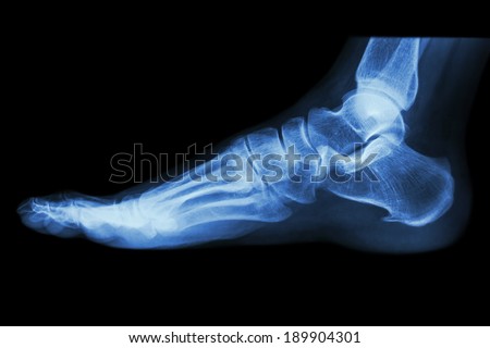X-ray normal human\'s foot lateral