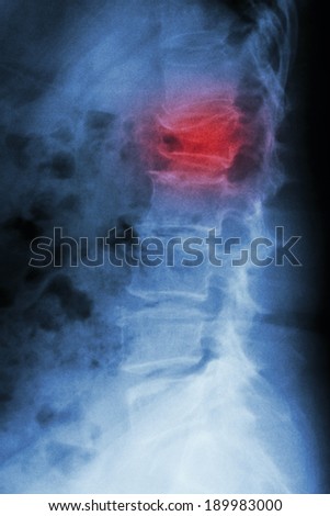 Film x-ray lumbar spine lateral : show burst fracture at lumbar spine (collapse at body of lumbar spine)