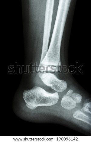 Film x-ray normal child\'s ankle