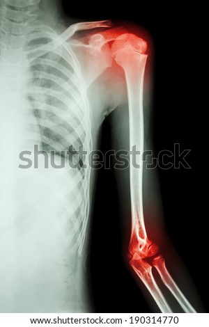 film x-ray left shoulder and arthritis at shoulder and elbow