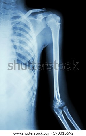 film x-ray normal shoulder