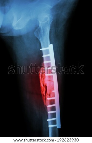 Fracture shaft of femur. It was operated and internal fixation by plate & screw
