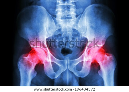 film x-ray human\'s pelvis and arthritis at both hip joint (Gout , Rheumatoid)