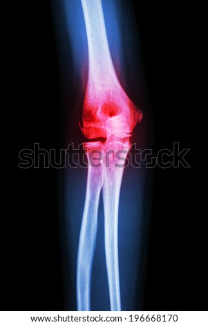 X-ray human\'s elbow and arthritis (Gout , Rheumatoid)