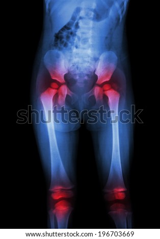 Film x-ray body of child (abdomen,buttock,thigh,knee) and arthritis at both hip , both knee (Gout,Rheumatoid)