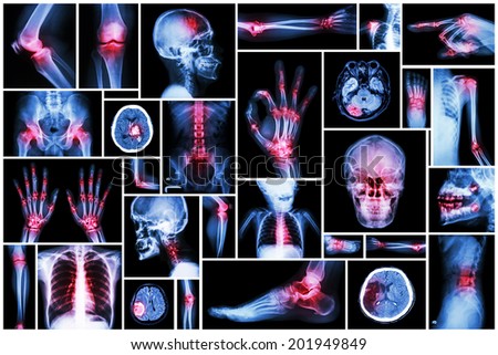 X-ray multiple part of human with multiple disease (stroke, arthritis, gout, rheumatoid, brain tumor, osteoarthritis, etc)