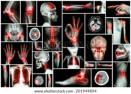 X-ray multiple part of human with multiple disease (stroke,arthritis,gout,rheumatoid,brain tumor,osteoarthritis,etc)