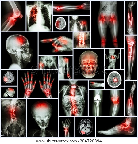 Collection X-ray part of human,Orthopedic operation,Multiple disease (Fracture,Gout,Rheumatoid arthritis,Osteoarthritis knee,Stroke,Brain tumor,Scoliosis,Tuberculosis, etc.)
