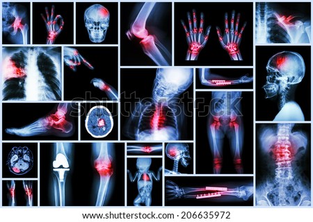 Collection X-ray multiple human\'s organ & orthopedic surgery & Multiple disease (Pulmonary tuberculosis , Gout , Rheumatoid arthritis ,Spondylosis , Fracture bone , Stroke , Brain tumor , etc)