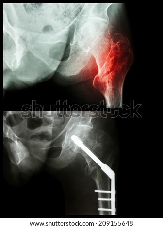 Intertrochanteric fracture left femur (fracture thigh\'s bone). It was operated and inserted intramedullary nail.