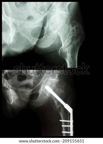 Intertrochanteric fracture left femur (fracture thigh\'s bone). It was operated and insert intramedullary nail.