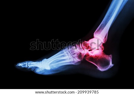 Arthritis at ankle joint (Gout , Rheumatoid arthritis)