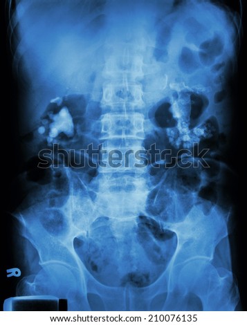 Bilateral renal calculi(staghorn) (Kidney stone)