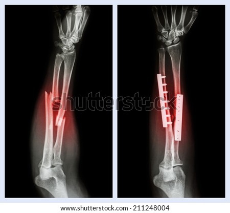 Fracture both bone of forearm. It was operated and internal fixed with plate and screw (Left image : before operation , Right image : after operation)