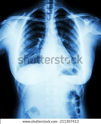 Normal chest x-ray of woman